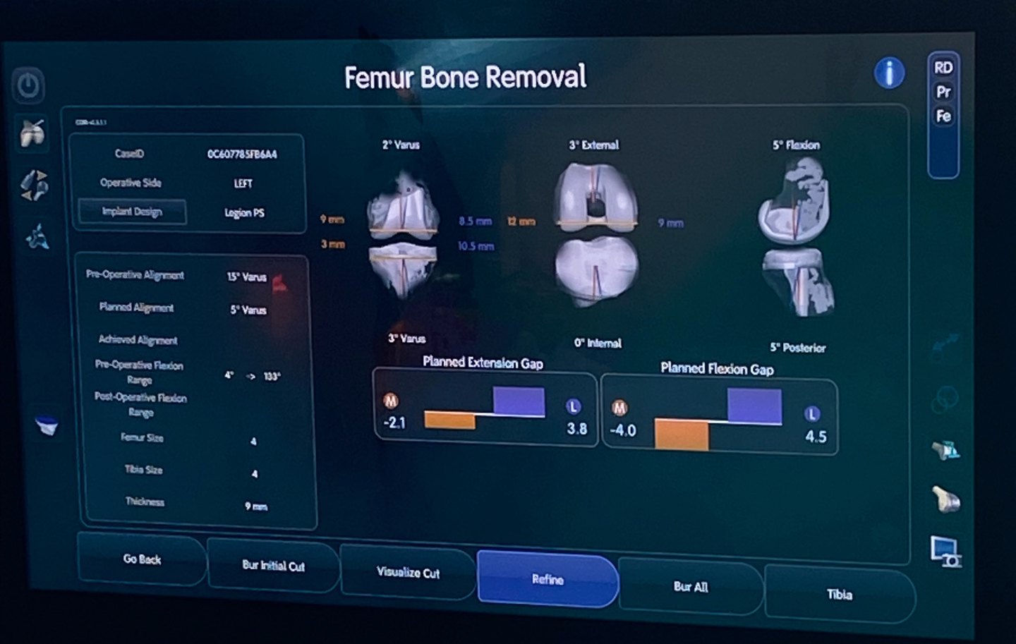Ekran komputera medycznego. Napis "Femur Bone Removal" i inne napisy medyczne po angielsku oraz parametry, trzy wizualizacje kości kolanowej.