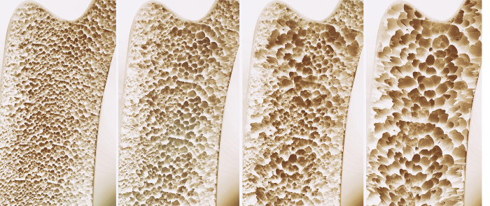 osteoporoza